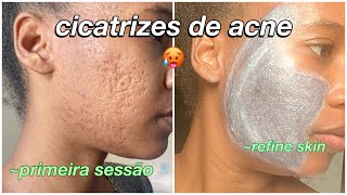 Cicatrizes de Acne  tratamento para remover cicatrizes refine skin [upl. by Balkin]