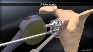 Apex Total Shoulder Arthroplasty Systems [upl. by Gnehp655]