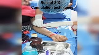 AVF Cannulation techniques  Dialysis patient cannulation dcdc ttt [upl. by Blase]