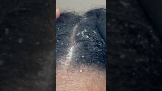 Psoriasis Scalp Relief itchyscalp [upl. by Tatman]