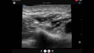 Supraclavicular brachial plexus block using butterfly IQ portable ultrasound system [upl. by Wawro862]