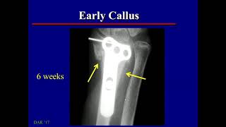 Normal Fracture Healing imaging findings [upl. by Yrekcaz478]