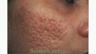 HOW TO GET RID OF ACNE SCARS [upl. by Aw66]