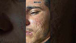 Acne scars treatment 03436470029 [upl. by Cicenia]