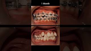 Crooked teeth braces dentist braces orthodontist dental [upl. by Turley]