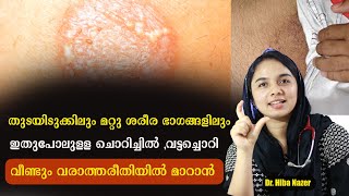 തുടയിടുക്കിലും മറ്റു ഭാഗങ്ങളിലും ഉള്ള ചൊറിച്ചിൽ വട്ടച്ചൊറി വീണ്ടും വരാത്തരീതിയിൽ മാറാൻ Dr Hiba [upl. by Bucher109]