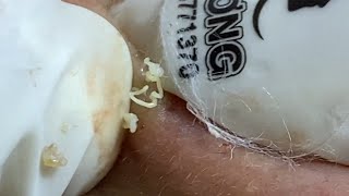 Acne Treatment Huong Da Nang  2024 Acne Huong 713 [upl. by Anircam]