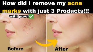 How did I remove my acne marks with just 3 products with proof [upl. by Anhaj]