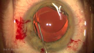 Treatment of Negative Dysphotopsia Reverse Optic Capture [upl. by Dougherty]