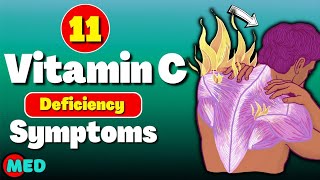 11 Vitamin C deficiency symptoms [upl. by Easlehc]