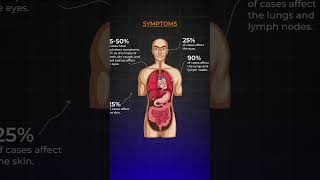 Know About Sarcoidosis I Akshar Pulmo Care sarcoidosis lungshealth science education [upl. by Scherman438]