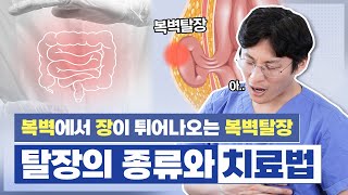 복벽탈장 탈장의 종류와 치료법로봇탈장수술 복벽이 약해지는 요인 [upl. by Effie]