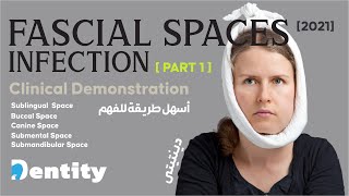 شرح مبسط  Fascial Spaces Infection  PART 12 [upl. by Ashjian]