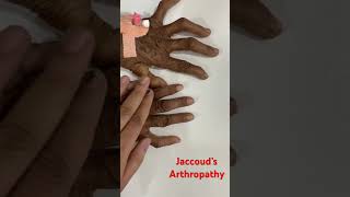 Jaccoud’s Arthropathy MedCAS [upl. by Lucais359]