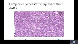 Endometrial hyperplasia Dr M Ramadan [upl. by Saxe881]