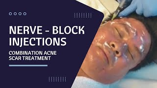 Nerve  Block Injections  Combination Acne Scar Treatment  Beverly Hills CA [upl. by Annmarie]