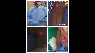 Endovenous laser ablation [upl. by Cut355]