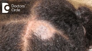 What causes Scalp Ringworm Effective Treatment   Tinea Capitis  Dr Tina Ramachander [upl. by Kermy]