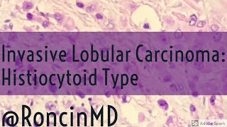 Short Review Invasive Lobular Carcinoma Breast  Histiocytoid Type [upl. by Silletram550]