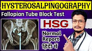 HSG Report Kaise Dekhe  HSG Test Painful Or Not In Hindi  HSG Test Kya Hota Hai  HSG Test Video [upl. by Aysa]