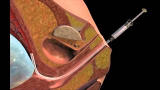 Chorionic Villus Sampling [upl. by Brindell246]