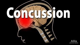 Concussion Pathophysiology Causes Symptoms and Treatment Animation [upl. by Niaz163]