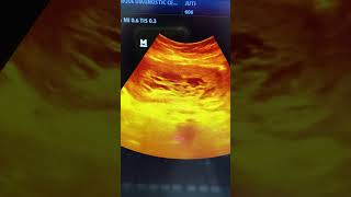 Hydatidiform mole HM ultrasound shorts shortvideo [upl. by Rosalinde]