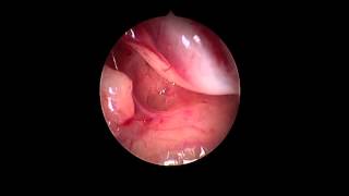 Endoscopic CSF Perilymph Leak [upl. by Laurella]