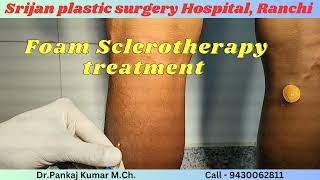 Foam Sclerotherapy treatment for varicose veins Varicose veins treatment for SSC GD Medical veins [upl. by Tewfik171]