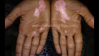 Vitiligo on Palm  Result after Melanocyte Transplantation at Maharshi Vitiligo Centre Mumbai [upl. by Kitty]