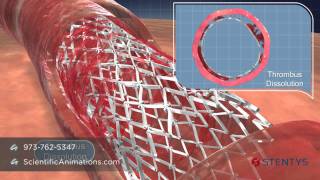 3D Medical Animation of Coronary Stent Procedure [upl. by Orteip]