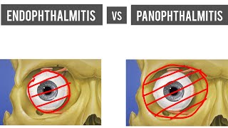 Endophthalmitis Vs Panophthalmitis Causes Diagnosis Treatment complications  Explained 👁️ [upl. by Sherrard]