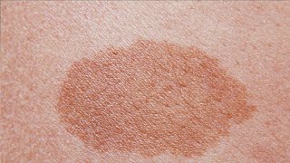 how to get rid of birthmarks naturally [upl. by Ahsaek]