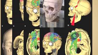 The connectomics of Phineas Gage [upl. by Ariada]