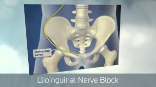 Dr Kornick Riverside Spine Jacksonville 904 3891010 Ilioinguinal Nerve Block [upl. by Cordy]