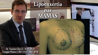 LIPOENXERTIA  Aumento das mamas com gordura  Dr Francisco Claro Jr [upl. by Khudari55]