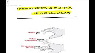 Easy mnemonic for swan neck deformity  mallet finger  boutaunniere deformity NeetPG [upl. by Einner]