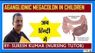 हिर्शप्रंग की बीमारी  AGANGLIONIC MEGACOLON HINDI [upl. by Alios]