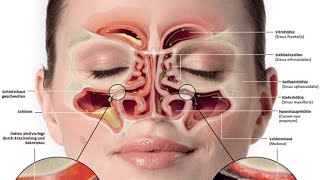 Chronische Sinusitis maxillaris [upl. by Maharg]