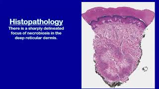 Lecture110 Necrobiotic Granulomatous Disorders of the Skin Rooks chapter 97 [upl. by Ikram]