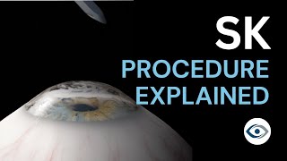 Superficial Keratectomy SK Procedure Explained  Precision Cornea Centre [upl. by Shirlene640]