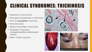 Trichinella SPIRALIS [upl. by Oiralih]