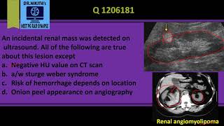 Renal angiomyolipoma Classical radiological features [upl. by Lori]