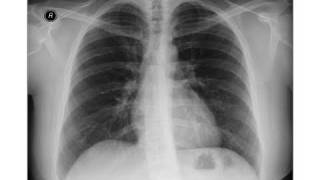 Chest xray Horizontal Fissure [upl. by Cissie]