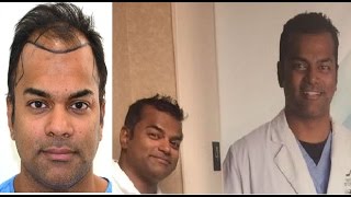 LIVE VIDEO of Hair Transplant in India at Medispa by Dr Suneet Soni Jaipur amp Delhi [upl. by Jacklyn]