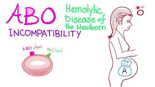 ABO Incompatibility  Hemolytic Disease Of The Newborn HDN  Hematology amp Pathology [upl. by Nireil]