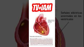 Cardioversión ⚡️en TV  SCA🫀 emergency uci [upl. by Klarika]