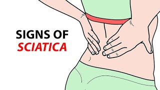 Signs of Sciatica [upl. by Haslam]