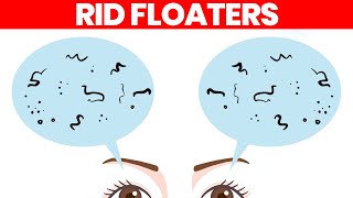 Eye Floaters What Are They amp How to Get Rid of Them [upl. by Sinnard111]