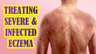 How To Manage Infected and Severe Eczema  Treatment Options [upl. by Smaoht]